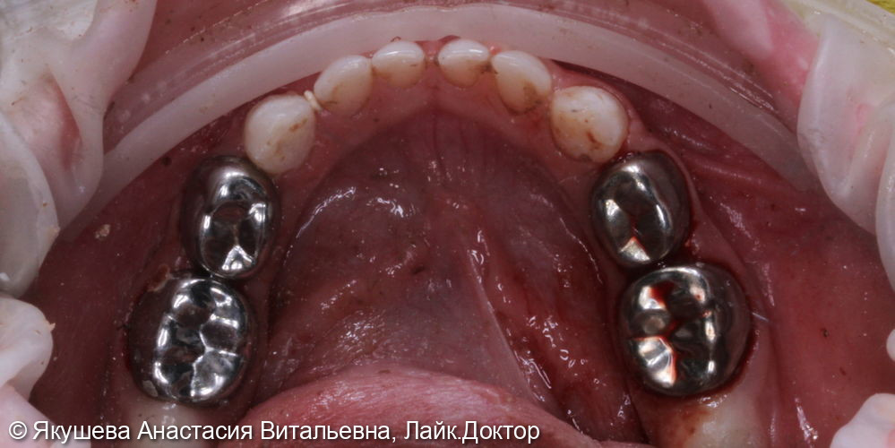 лечение во сне пациента х лет 17ти зубов за 2,5 часа - фото №6