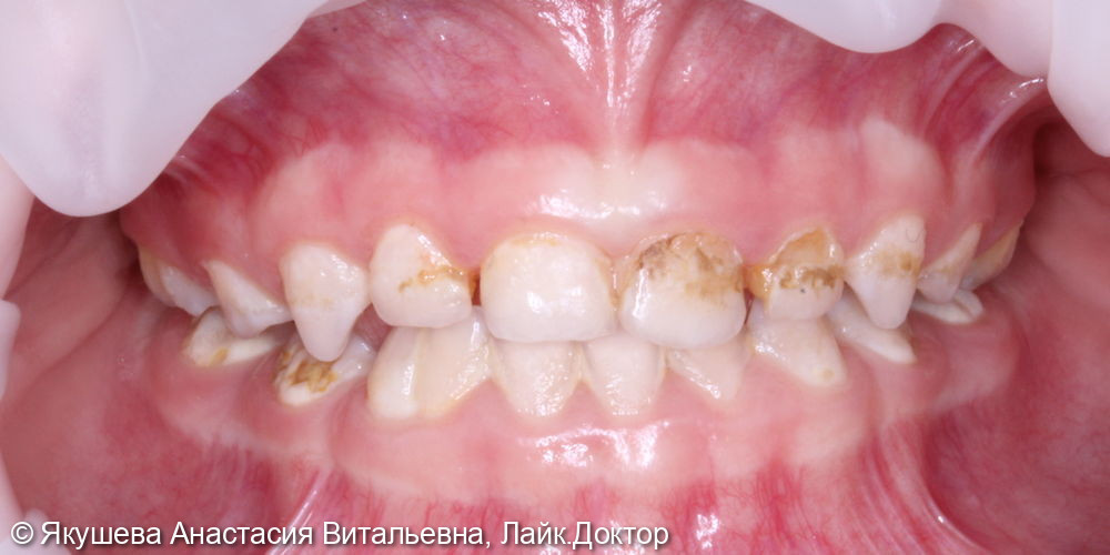 ребенок 3года, лечение во сне 12-ти зубов за 1 час 45 мин - фото №1