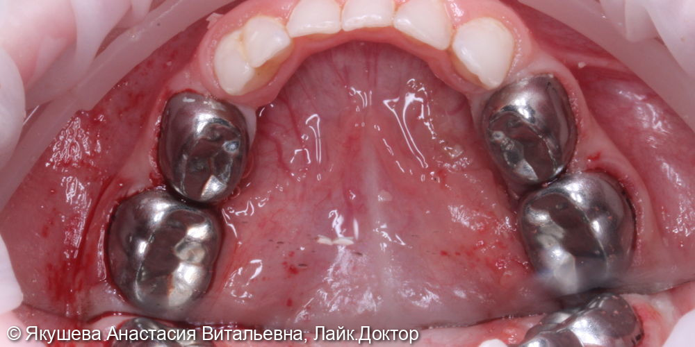 ребенок 3года, лечение во сне 12-ти зубов за 1 час 45 мин - фото №6