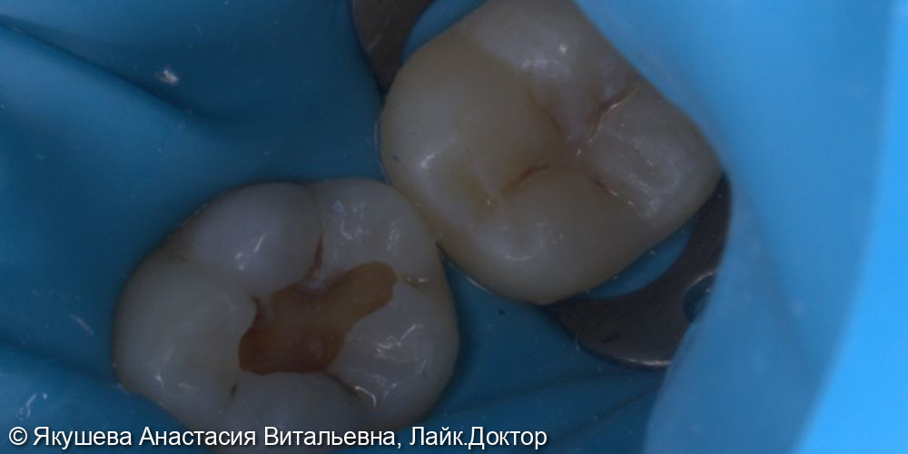 пациент15 лет, лечение кариеса постоянных зубов - фото №1