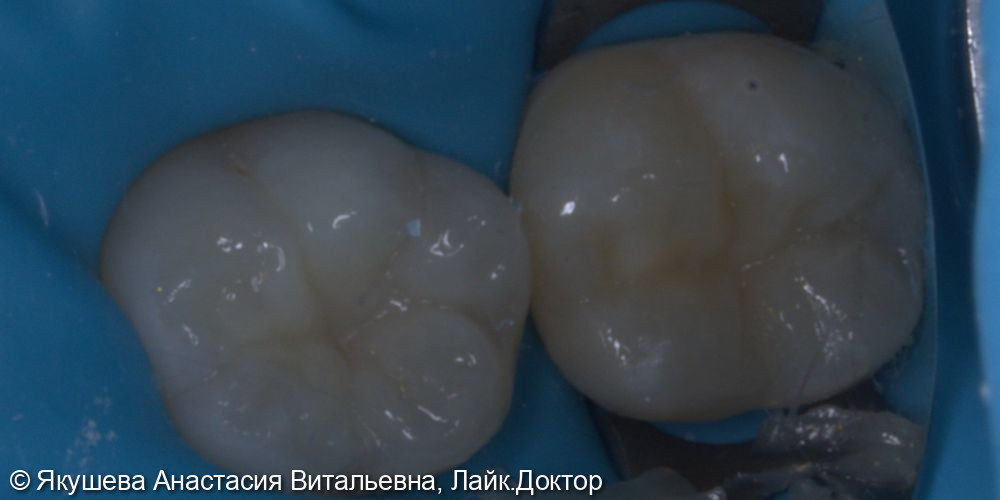 пациент15 лет, лечение кариеса постоянных зубов - фото №4