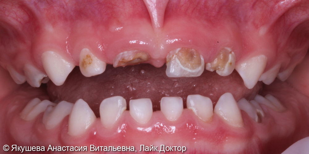 ребенок 4 года, лечение 14 зубов во сне - фото №1