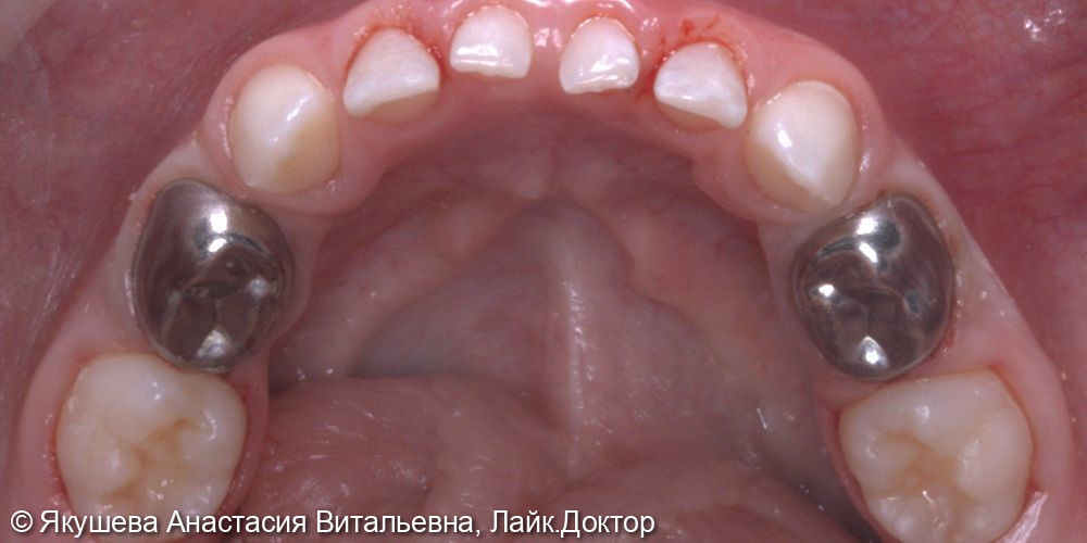 ребенок 4 года, лечение 14 зубов во сне - фото №6