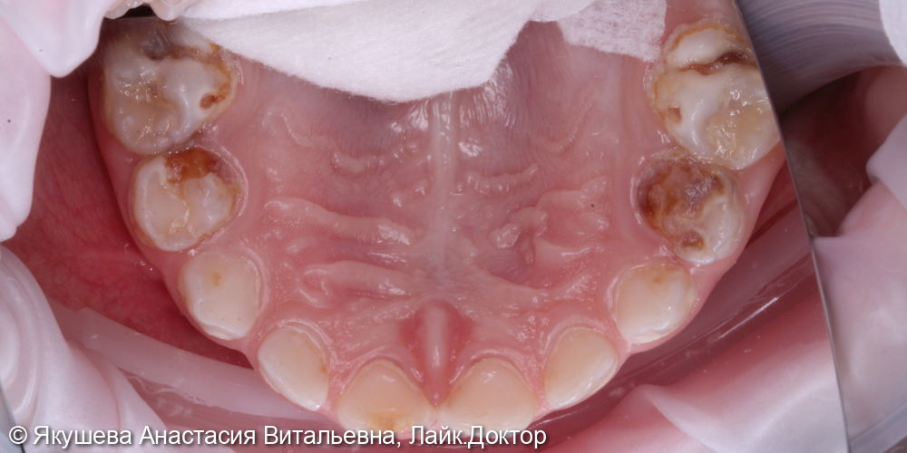 малыш, 3 года, лечение во сне 16 зубов - фото №1