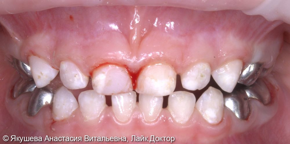 малыш, 3 года, лечение во сне 16 зубов - фото №6