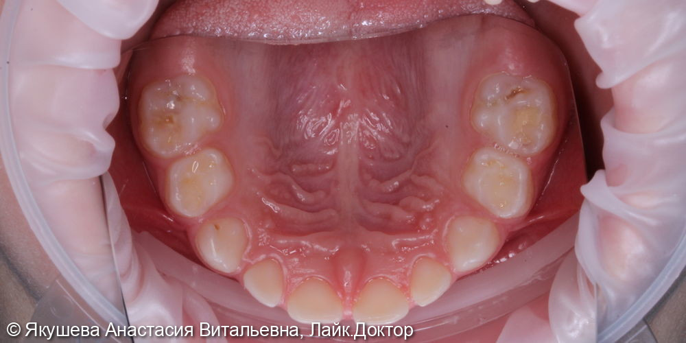 малыш 4 года, лечение во сне 7ми зубов - фото №1