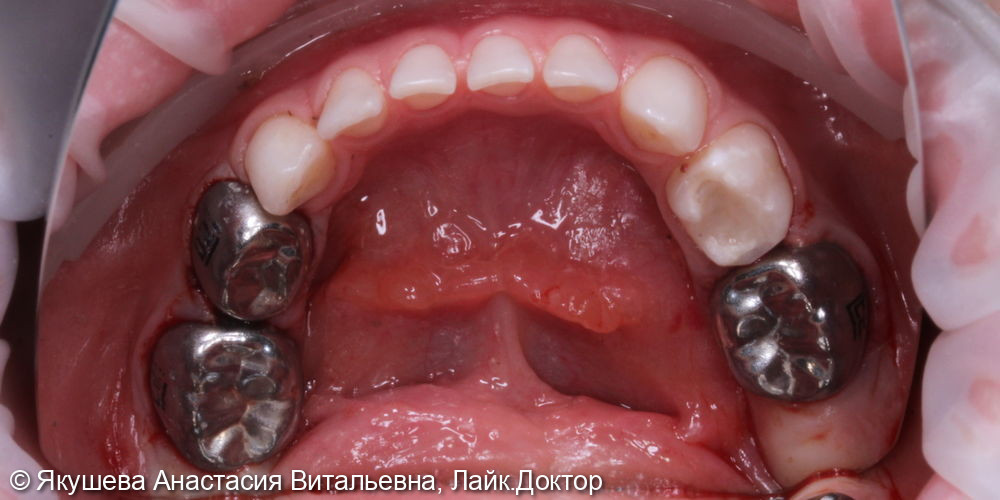 малыш 4 года, лечение во сне 7ми зубов - фото №4