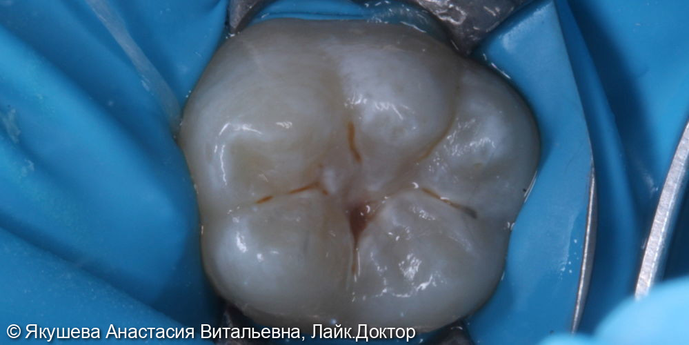 лечение кариеса постоянного зуба - фото №1