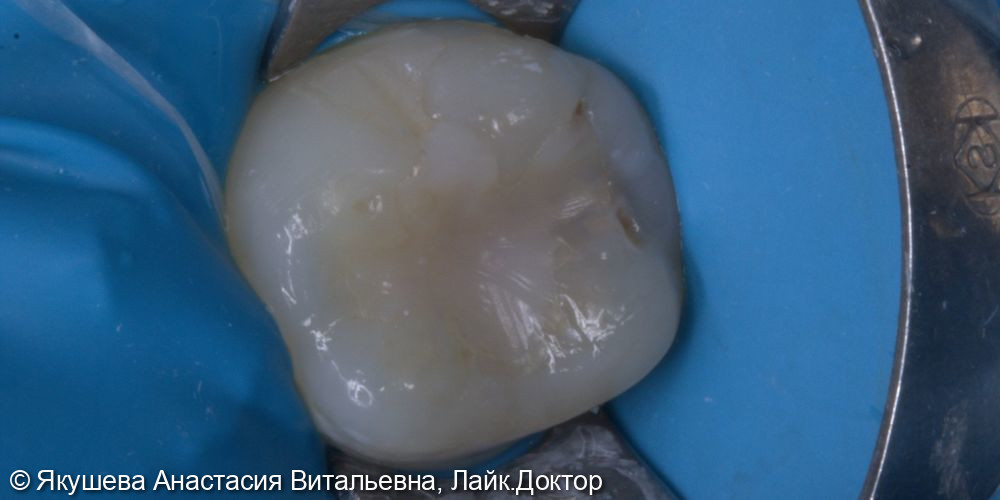 лечение вторичного кариеса постоянного зуа - фото №1