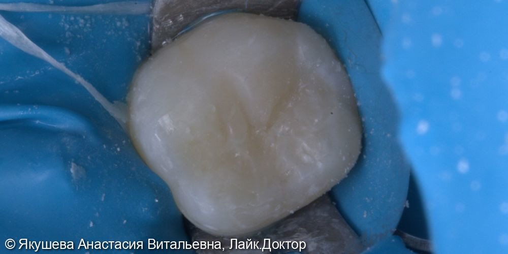 лечение вторичного кариеса постоянного зуа - фото №4