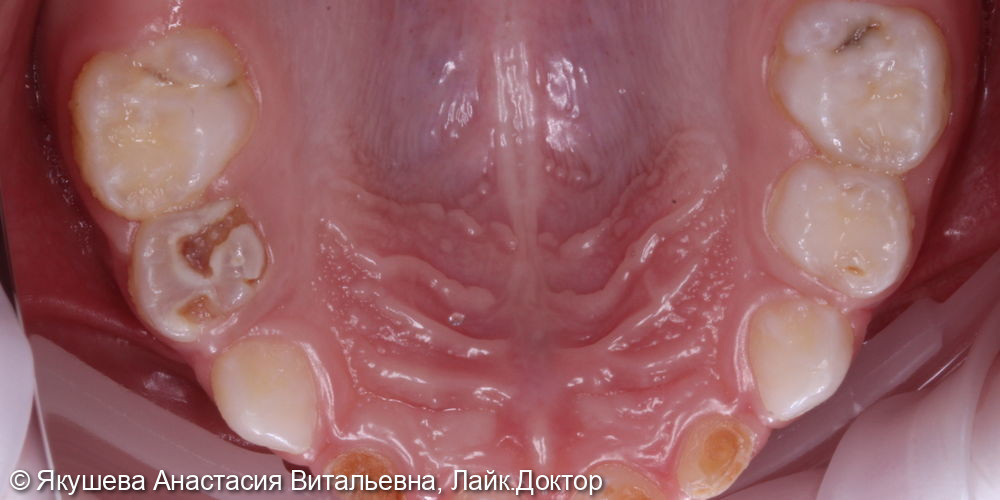 лечение пациента 4года во сне.10зубов - фото №1