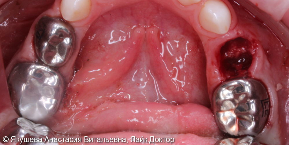 лечение пациента 4года во сне.10зубов - фото №4