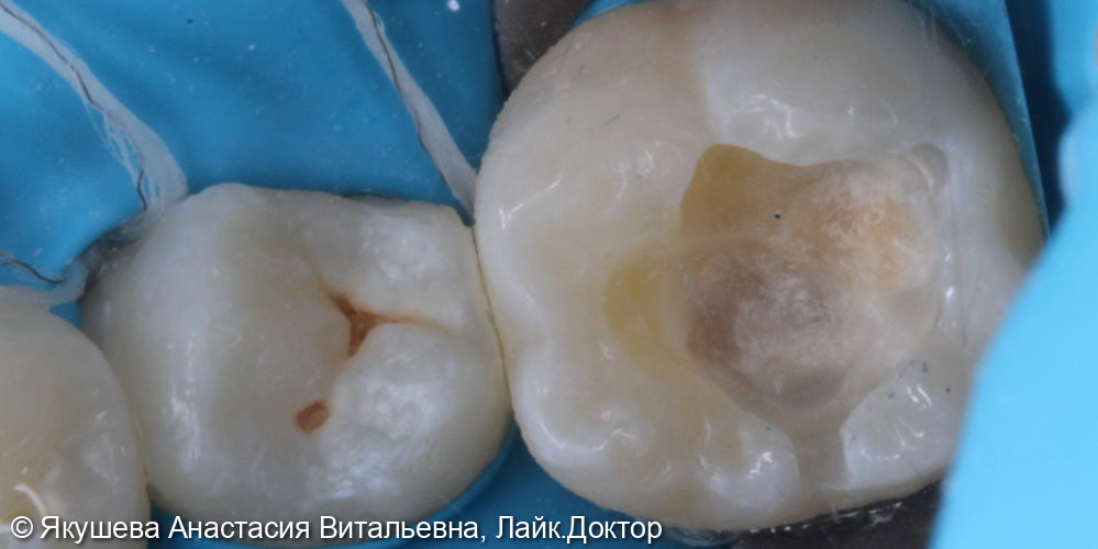 кариес 35,36 фото 2 · Вологда