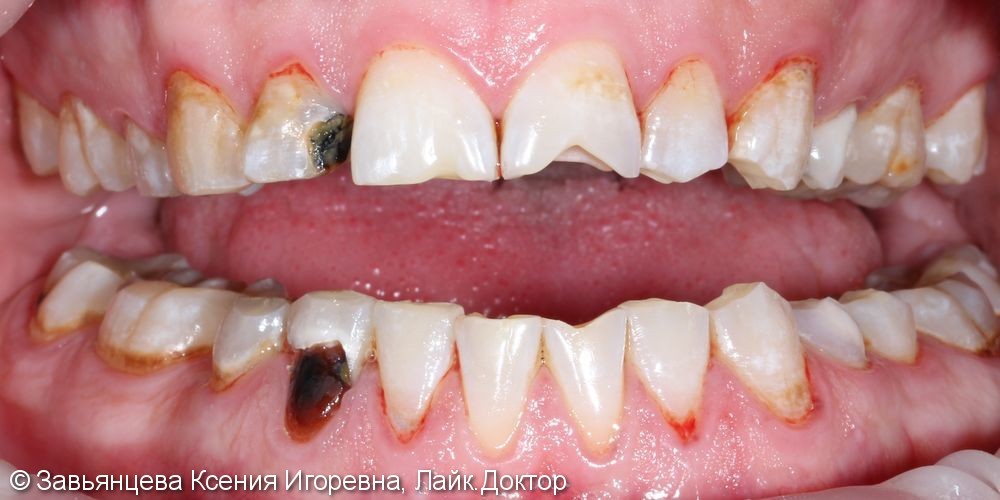 Лечение кариеса зубов на верхней и нижней челюсти - фото №1