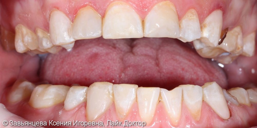 Лечение кариеса зубов на верхней и нижней челюсти - фото №2