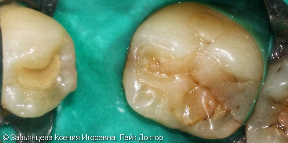 Лечение среднего кариеса 3.4 и 3.6 зуба - фото №1