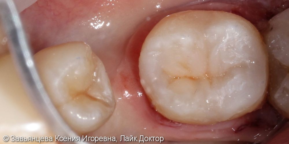 Лечение среднего кариеса 3.4 и 3.6 зуба - фото №2