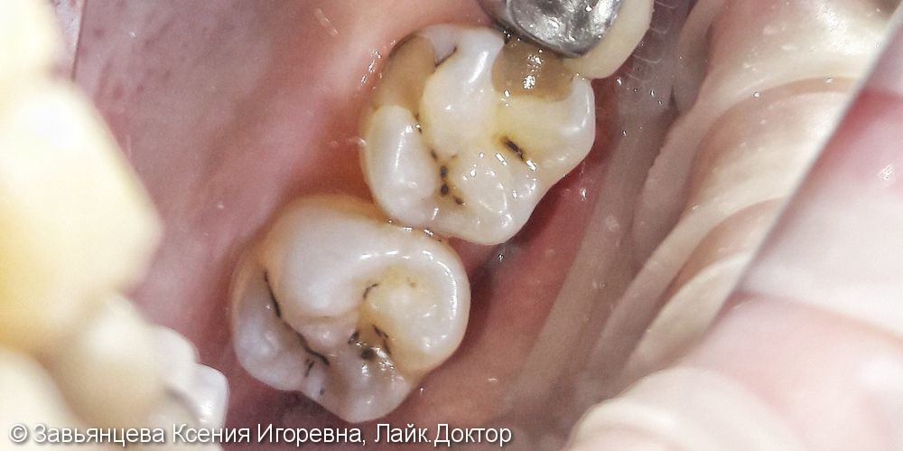 Лечение глубокого кариеса  1.6 и 1.7 зуба - фото №1