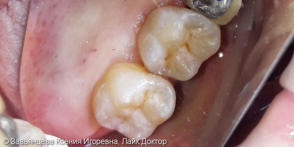 Лечение глубокого кариеса  1.6 и 1.7 зуба - фото №2