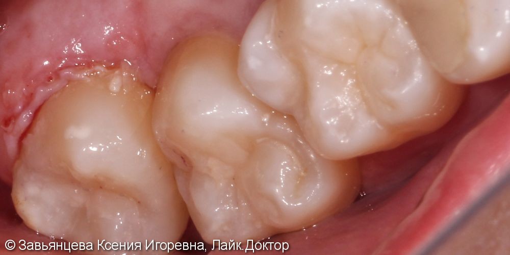 Лечение вторичного среднего кариеса зубов 1.8-1.7 материалом Filtek Ultimate - фото №2