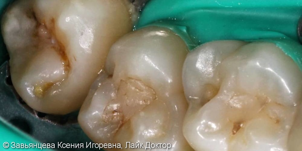Лечение вторичного среднего кариеса зубов 1.8-1.7 материалом Filtek Ultimate - фото №1