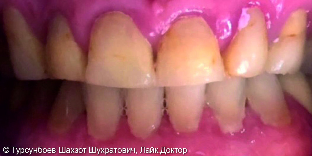 Установка циркониевых коронок на фронтальные зубы - фото №1