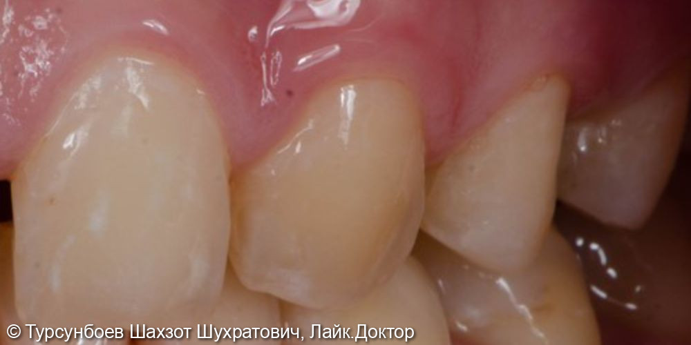 Установка циркониевых коронок на фронтальные зубы - фото №1