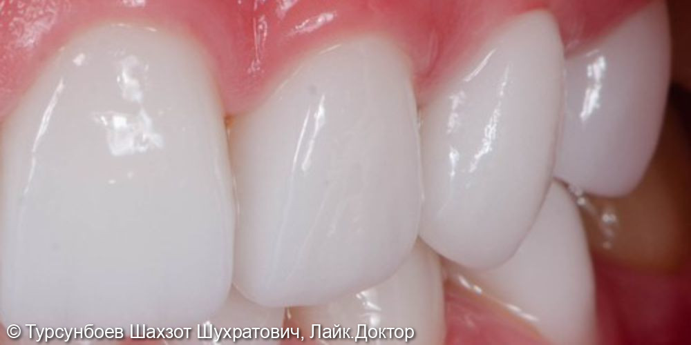 Установка циркониевых коронок на фронтальные зубы - фото №2