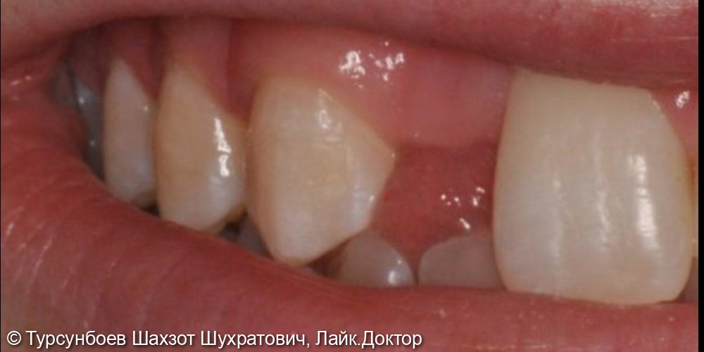 Восстановление отсутствующих зубов методом имплантации - фото №1