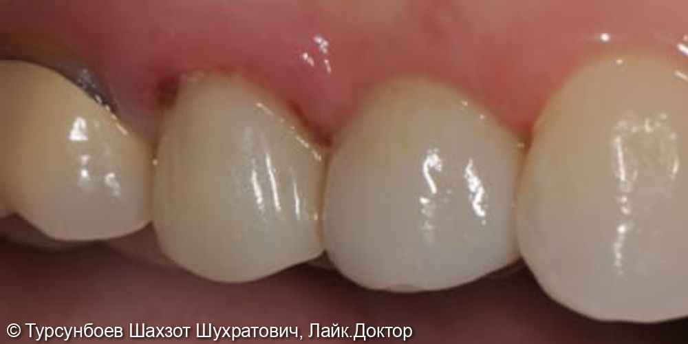 Восстановление отсутствующих зубов методом имплантации - фото №2