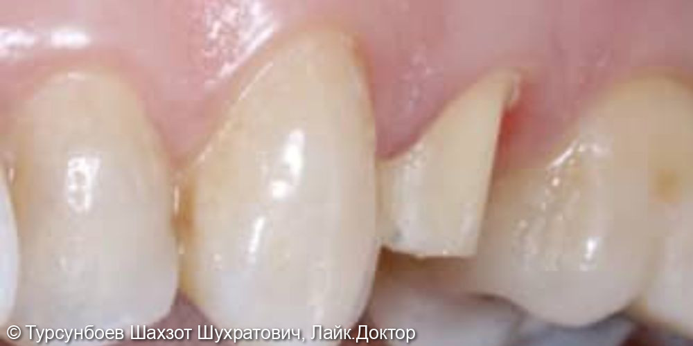 Установка ортопедической коронки из диоксида циркония на зуб - фото №1