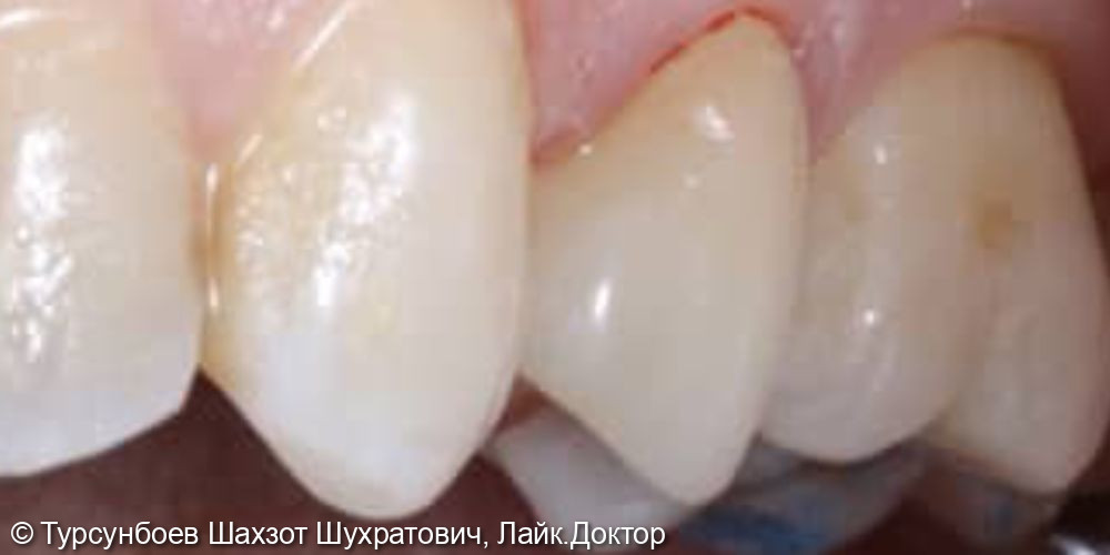 Установка ортопедической коронки из диоксида циркония на зуб - фото №2