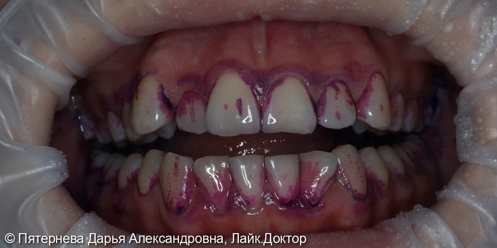 Профессиональная гигиена полости рта по технологии GBT - фото №1