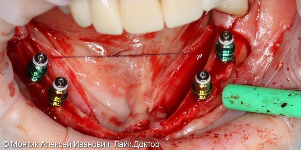 Имплантация в области нижней челюсти с помощью расщепления альвеолярного гоебня - фото №3