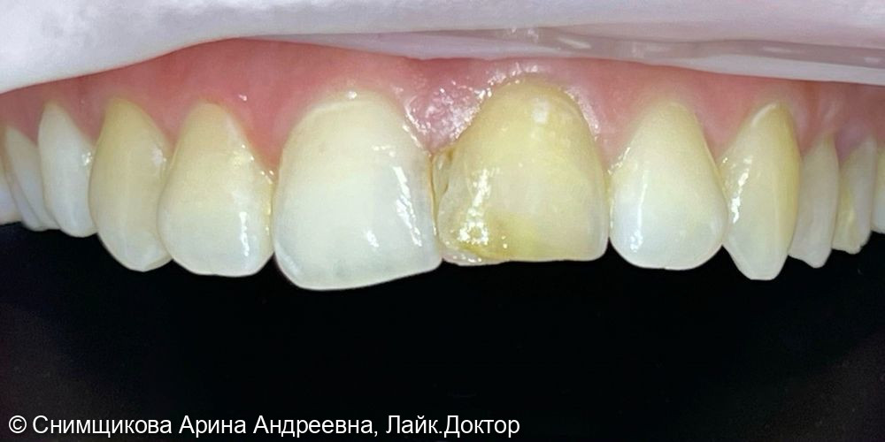 Внутрикоронковое отбеливание, лечение кариеса и реставрация переднего зуба - фото №1
