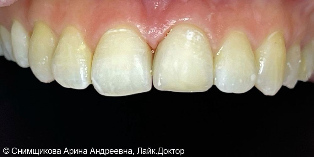 Внутрикоронковое отбеливание, лечение кариеса и реставрация переднего зуба - фото №2