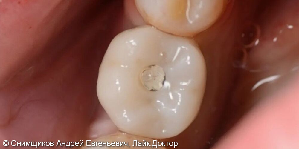 Протезирование зуба на импланте - фото №2