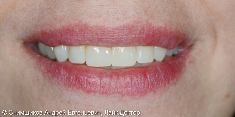 Лечение зубов, протезирование зубов верхней челюсти, отбеливание зубов нижней челюсти - фото №2