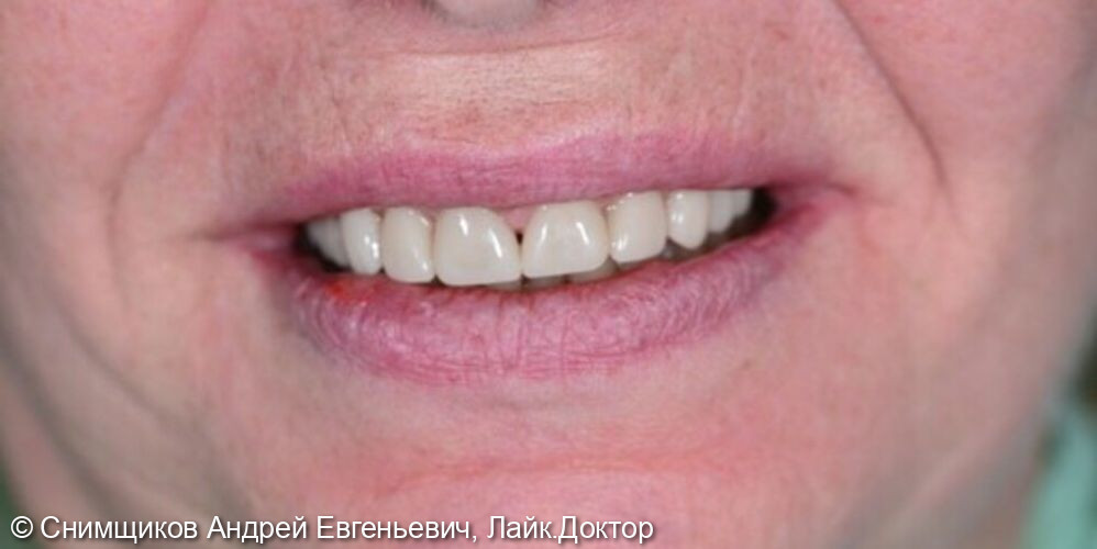 Лечение и протезирование зубов - фото №2
