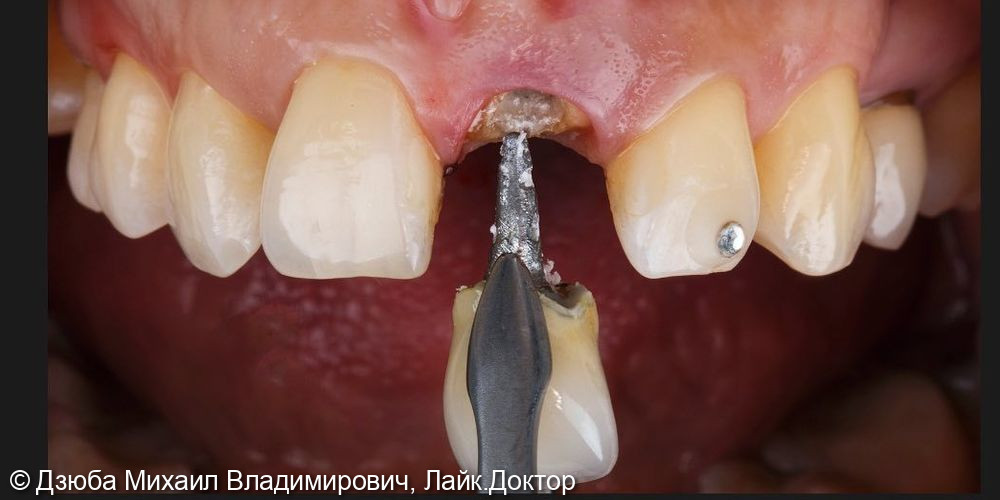 Одномоментная имплантация центрального зуба - фото №1