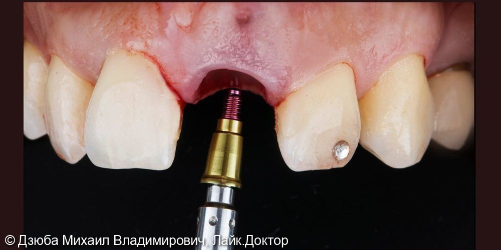 Одномоментная имплантация центрального зуба - фото №3