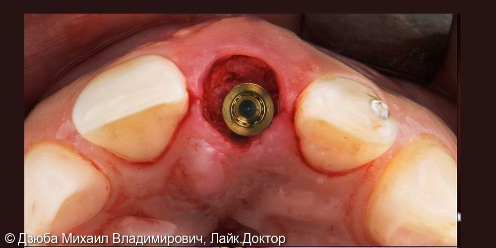 Одномоментная имплантация центрального зуба - фото №4