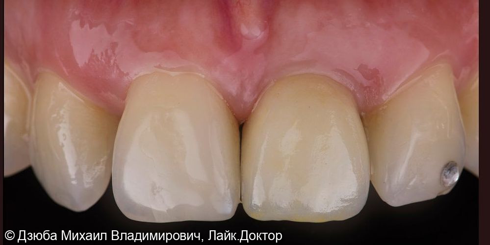 Одномоментная имплантация центрального зуба - фото №7