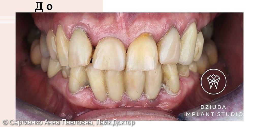 Протезирование на зубах и имплантатах - фото №1