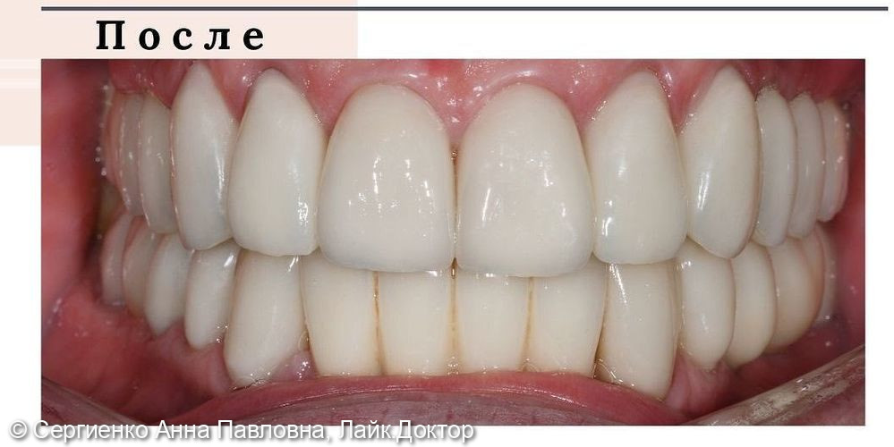 Протезирование на зубах и имплантатах - фото №6