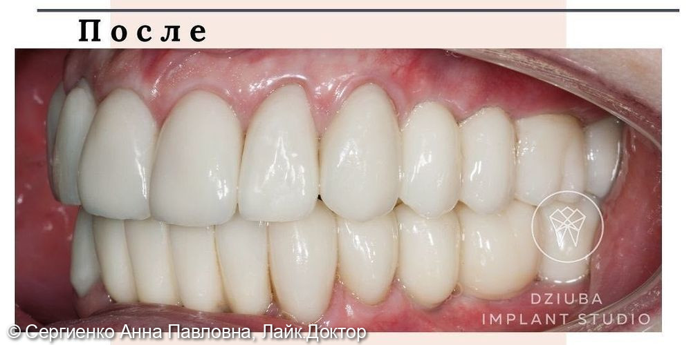 Протезирование на зубах и имплантатах - фото №3