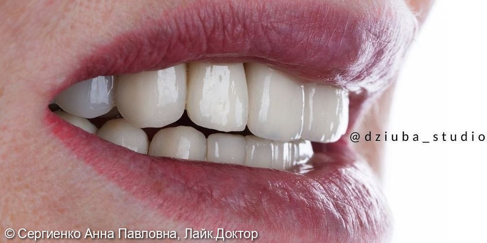 Протезирование на зубах и имплантатах - фото №4