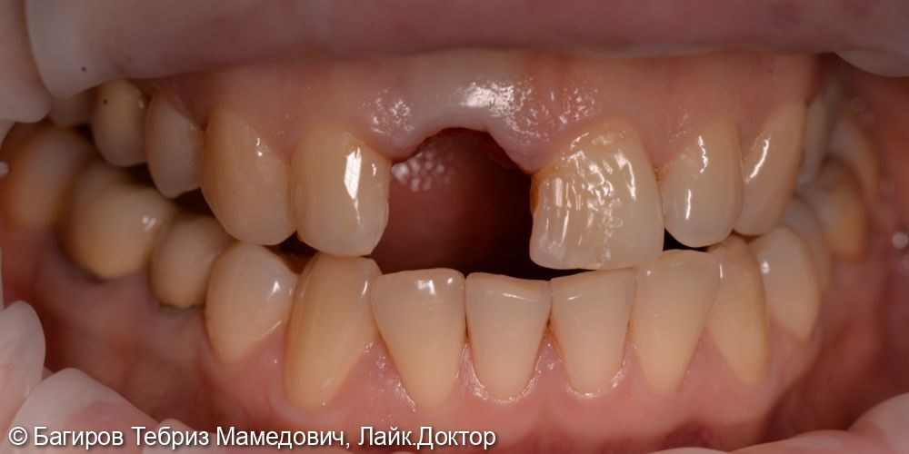 Имплантация переднего зуба и эстетическая реабилитация зубов винирами - фото №1