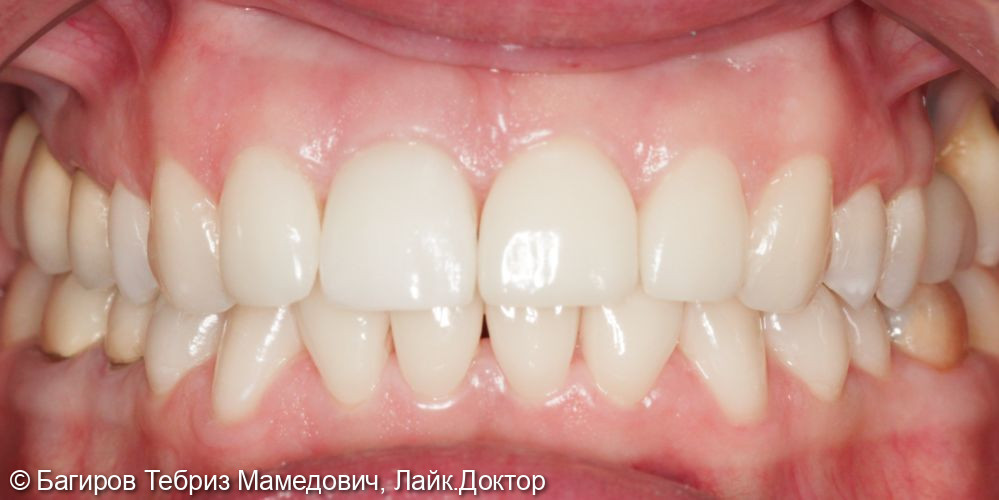 Имплантация переднего зуба и эстетическая реабилитация зубов винирами - фото №2