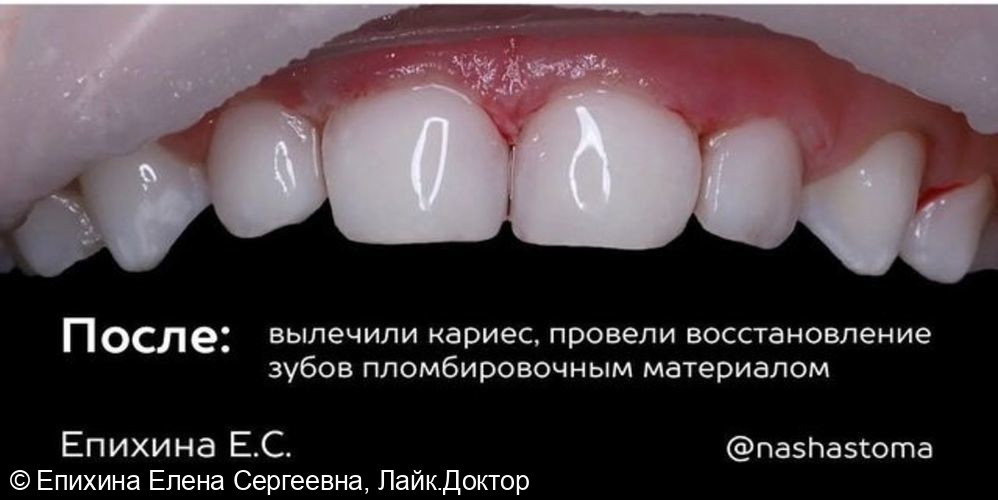 Лечение кариеса у ребенка фото 2 · Санкт-Петербург